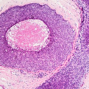 Preventing Spread of Early-Stage Breast Cancers