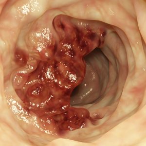 African-Americans More Likely to Receive Substandard Gastrointestinal Cancer Care