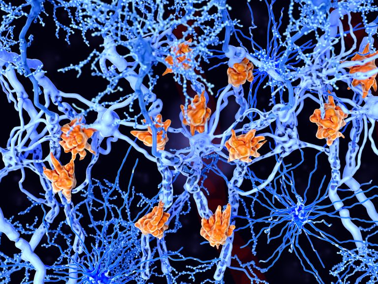 Multiple sclerosis (MS): microglia cells damage the myelin sheath of neuron axons.