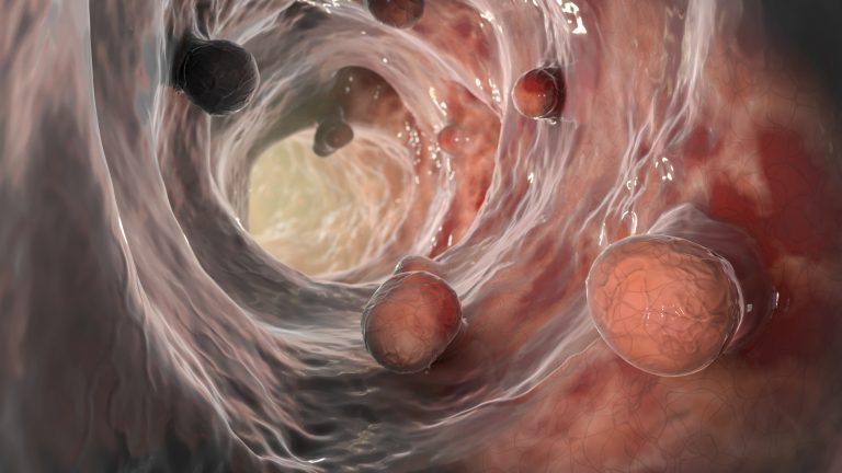 Colorectal cancer illustration showing a view from inside the intestine