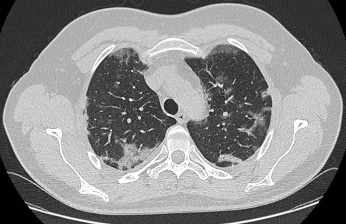 Computed tomography scan in a patient with viral pneumonia caused by SARS-CoV-2