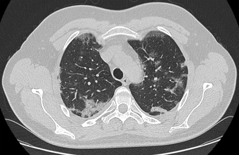Lung Cancer Follow-Up Delays Common After High-Risk Screening Result