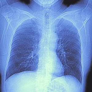 Chest Imaging Can Improve Outcomes for CRC Patients with Lung Metastases