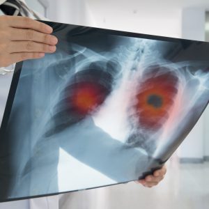 Survival Rates of Newly Diagnosed Stage 4 NSCLC Patients Improved by Molecular Testing Prior to Treatment