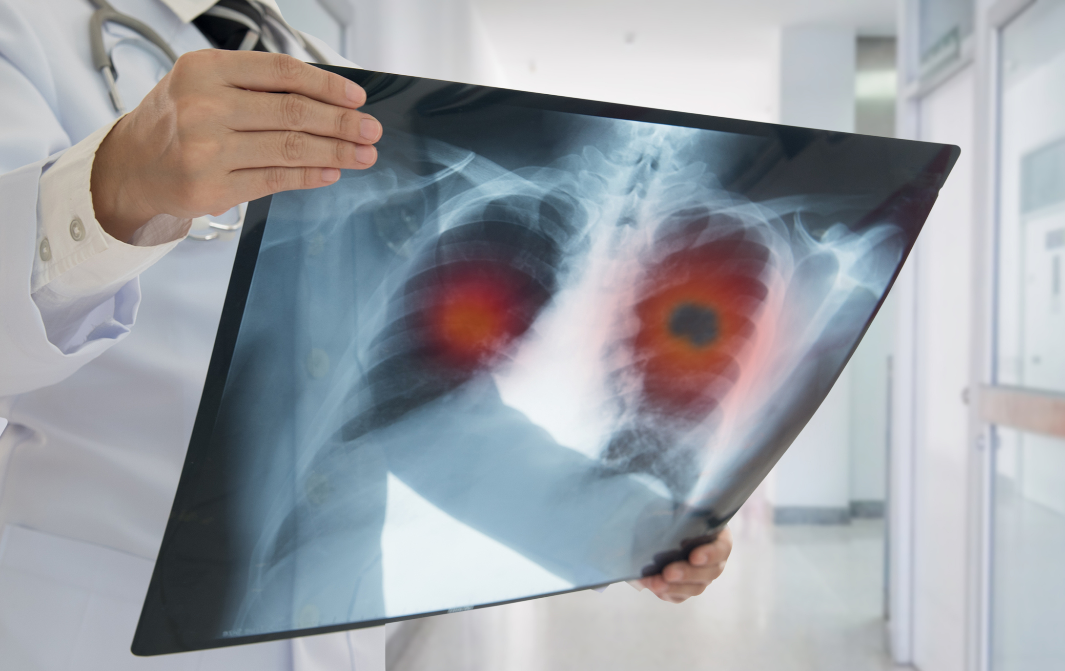 Lung Tumors Hijack Nerve Signals to Drive Cachexia, Opening New Therapeutic Target