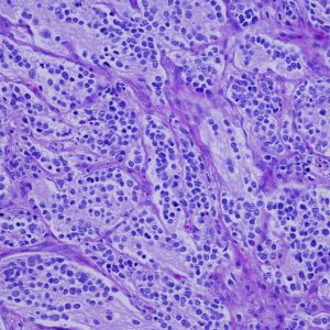 CAR-NKT Therapy against Neuroblastoma Shows Promising Results in Clinical Trial