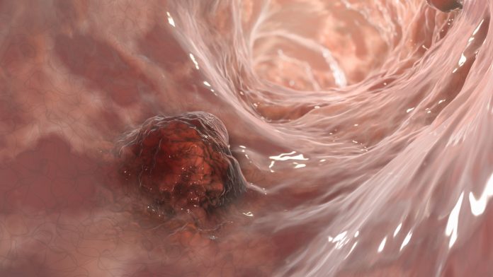 Intestinal carcinoma, colorectal cancer, bowel neoplasia, 3D illustration
