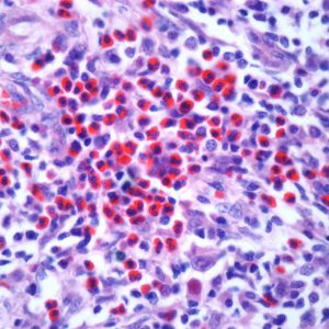 Early-Stage Hodgkin Lymphoma Patients Have High Cardiovascular Risk