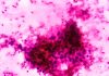 Giant-Nucleus Cells Linked to Early-Stage Cancer and Ferroptosis Resistance
