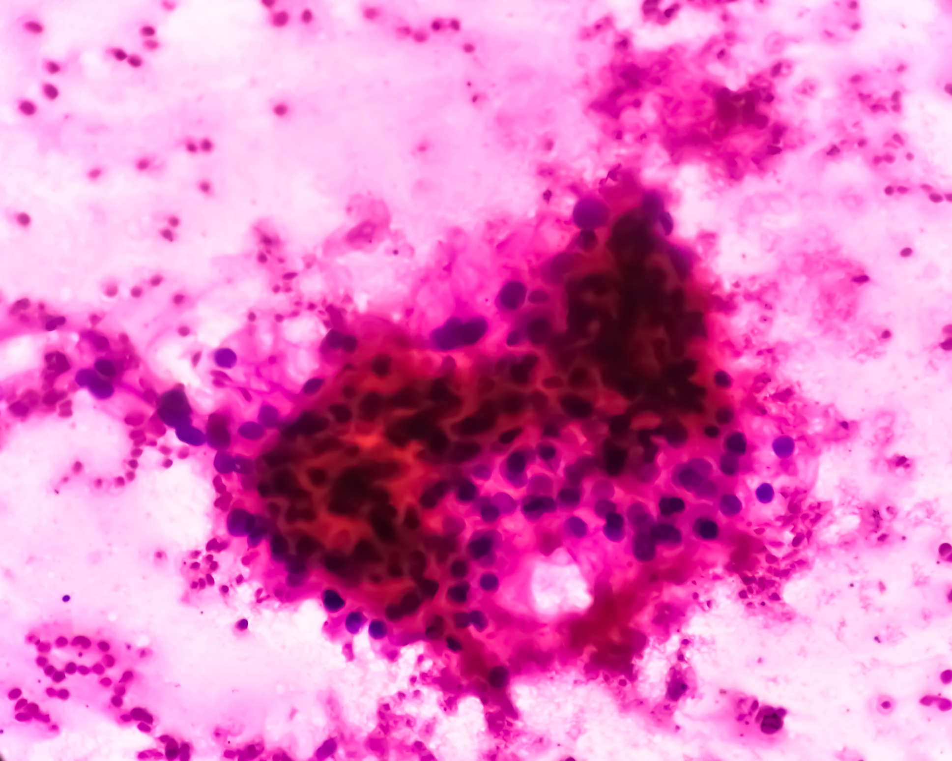 Photo: Insideprecisionmedicine Giant-Nucleus Cells Linked to Early-Stage Cancer and Ferroptosis Resistance