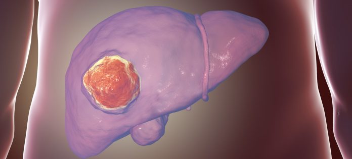 Liver cancer, illustration