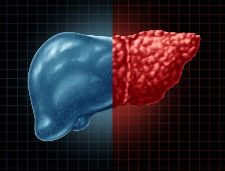 Fatty Liver Disease, MASLD