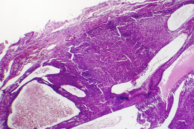 Fibrosarcoma, malignant tumor of fibroblasts