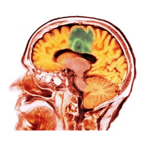 Federated Learning Model Delivers Big Data on Glioblastoma for Diagnosis