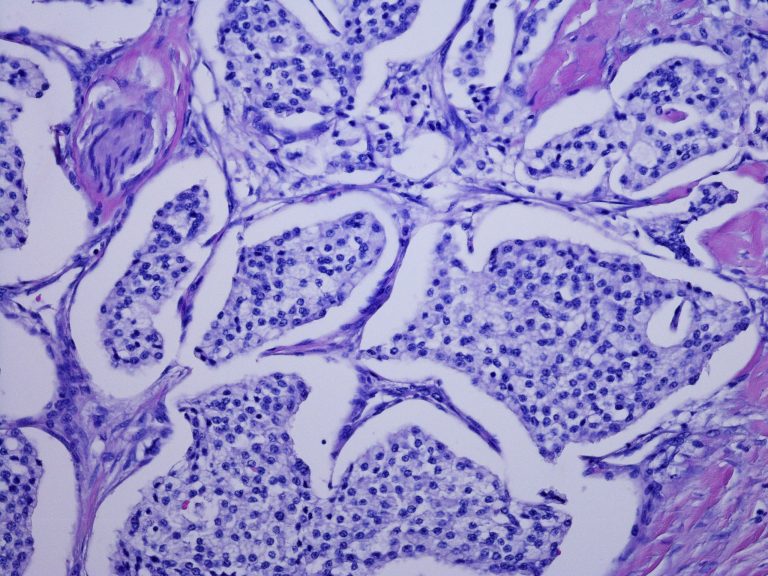 Micrograph of pancreatic neuroendocrine tumor, clear cell variant