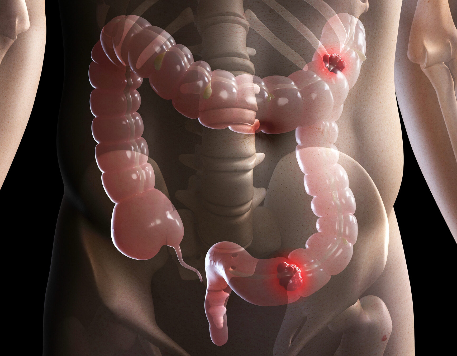 AI Helps Tailor Better Therapy for Bowel Cancer