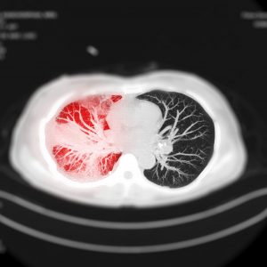 RadNet, Google Health Collaborate to Develop AI-Based Lung Nodule Malignancy Diagnostic