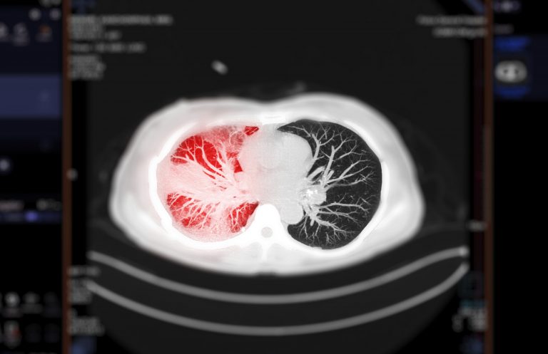 Selective focus of CT scan of Chest or lung axial mip view of lung infection covid-19 with ground glass opacity .