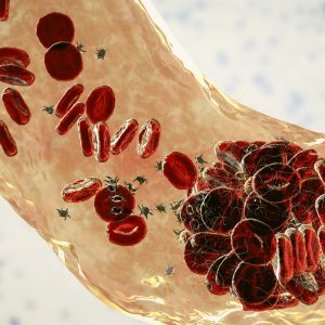 Risk of Venous Thromboembolism after COVID-19 Low in Non-Hospitalized Patients