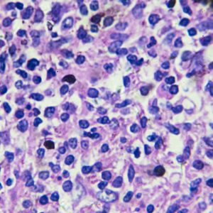 Roche Bi-Specific Antibody Approved by FDA for a Relapsed or Refractory Form of Non-Hodgkin Lymphoma