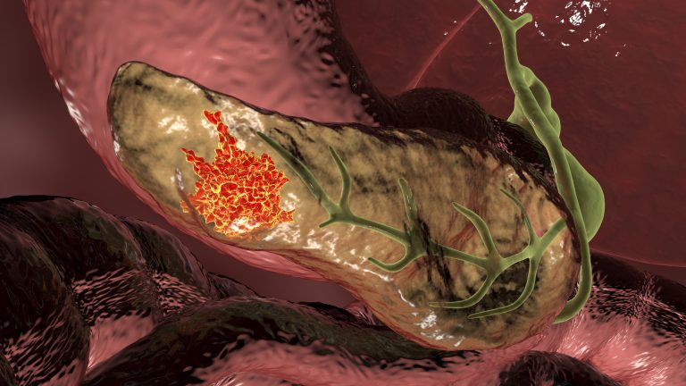Illustration showing a pancreas with pancreatic cancer highlighted in red.