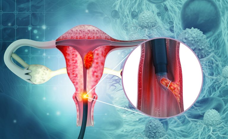 Dilation and curettage (d and c).endometrial biopsy.cervical cancer.3d illustration