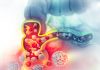 Chemotherapy Before Surgery Lowers Colon Cancer Recurrence Risk