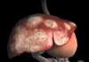 Novel siRNA Drug Delivery Halts Tumor Growth in Aggressive Pediatric Liver Cancer