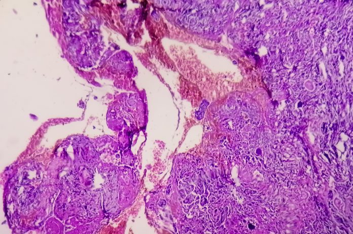 Spinal tumor biopsy: Psammomatous meningioma. Psammoma bodies.