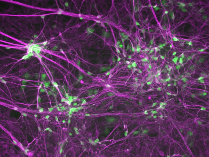 A microscope image of human induced motor neurons that are labeled with a motor neuron marker HB9 in green and a neuron marker TUJ1 in purple to illustrate ALS or Lou Gehrig’s disease