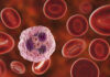 Neutrophils Major Culprits in Pancreatic Cancer Treatment Resistance