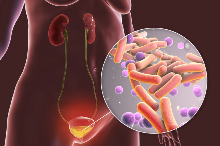Illustration of the bottom half of a female body showing the bladder and kidneys highlighted with a circle to the right of the image filled with bacteria indicating a urinary tract infection