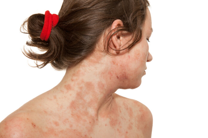 Head and shoulders photo of a young woman showing she has the skin disorder atopic dermatitis or eczema