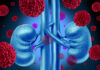 Immunotherapy Significantly Extends Survival Post-Kidney Cancer Surgery