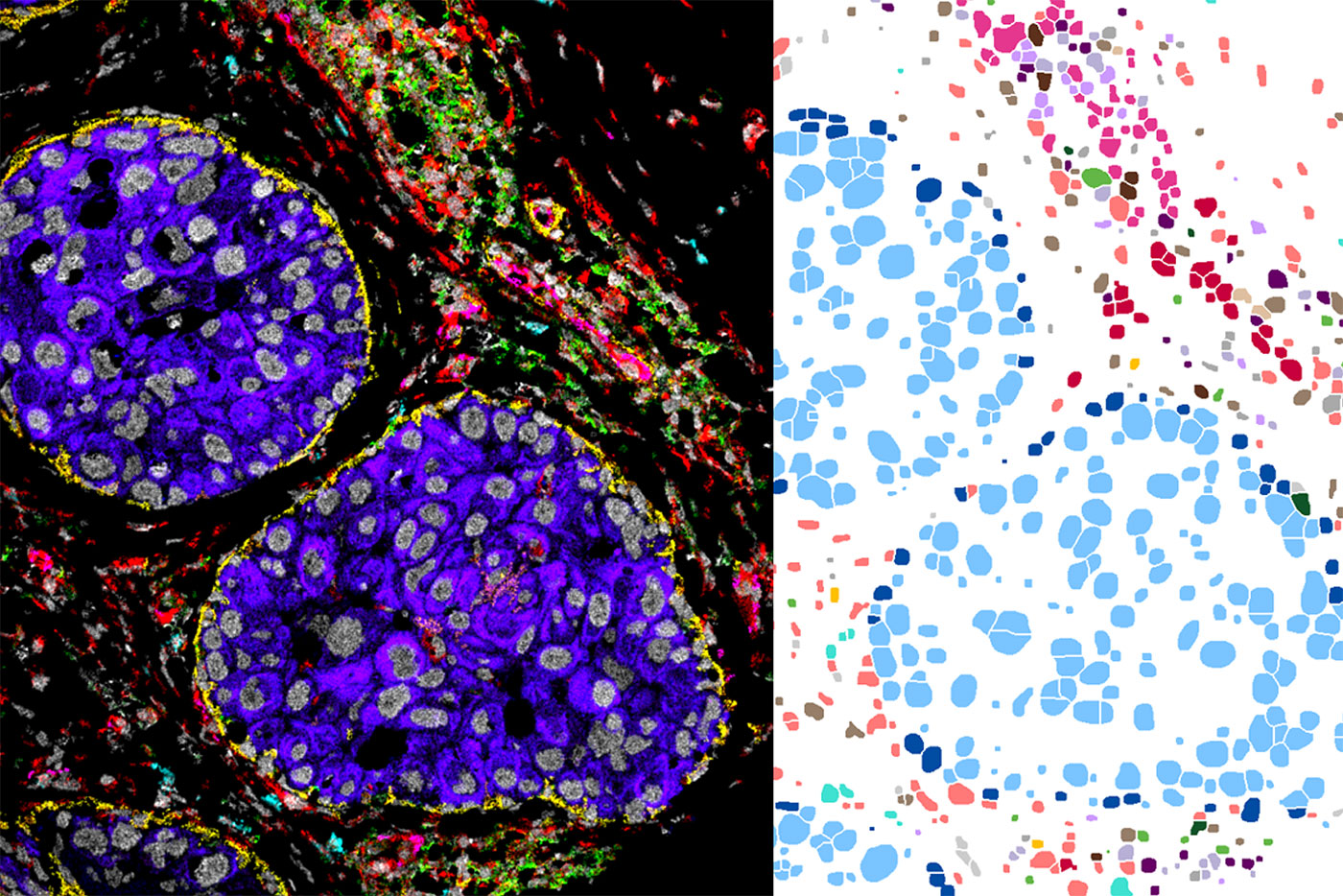 High-Resolution Spatial Proteomics Accelerates Personalized Insights Into Cancer