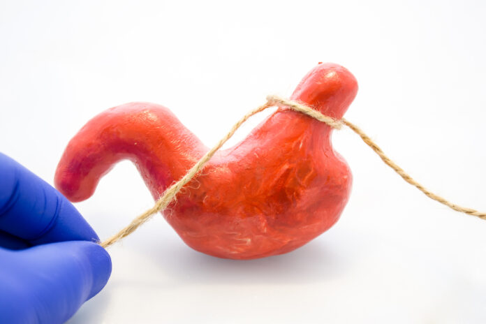 bariatric or stomach banding surgery for weight loss or treatment of diaphragmatic hernia concept photo. Doctor pinched anatomical model of stomach using rope, preventing flow of food, showing procedure