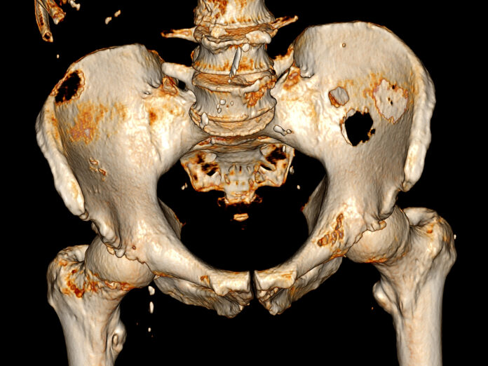 Multiple osteolytic metastases seen on CT Scan of pelvic bone with both hip joint 3D rendering image