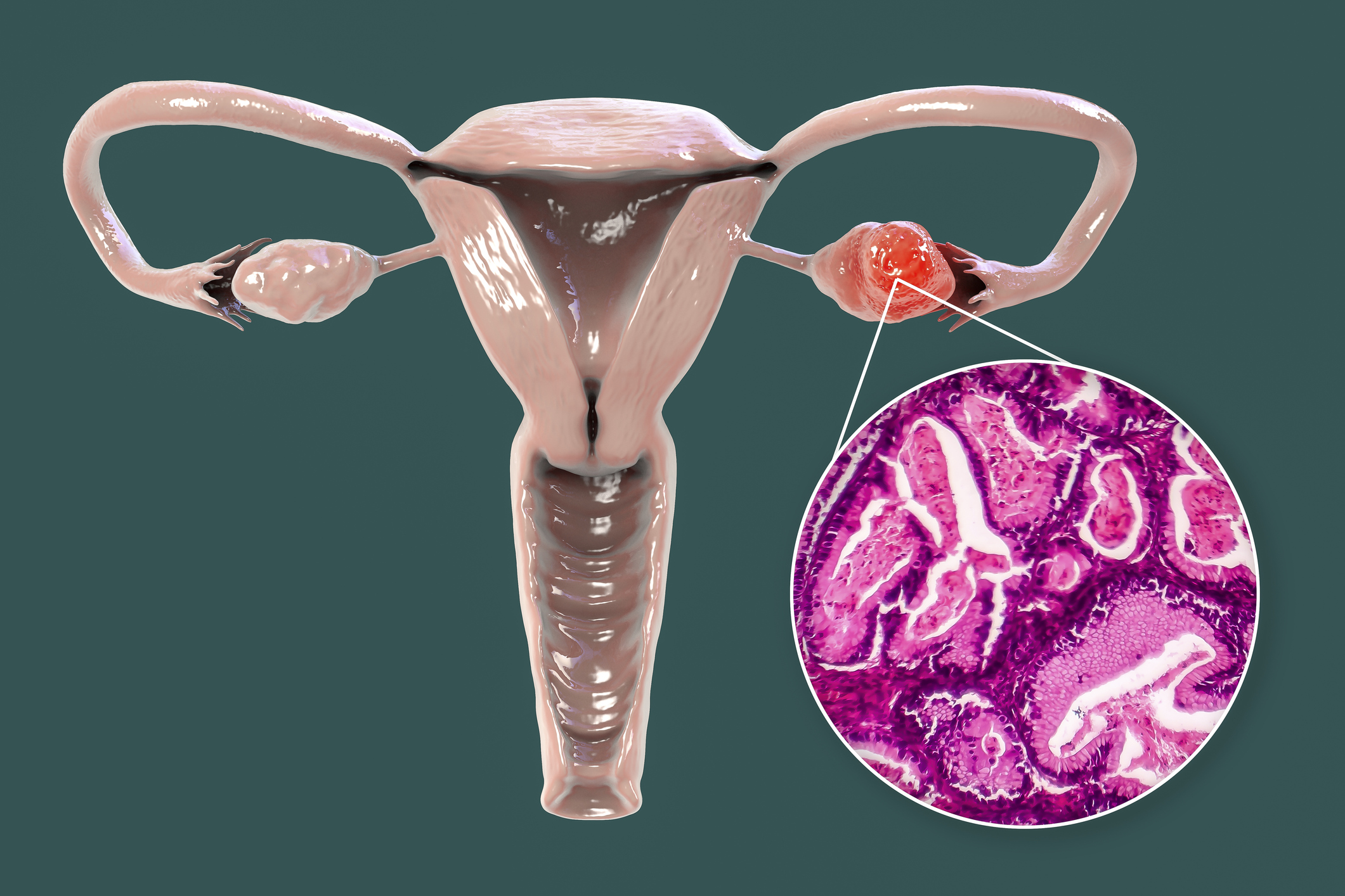 Distinct Ovarian Cancer Evolution States May Offer Personalized Treatment Options