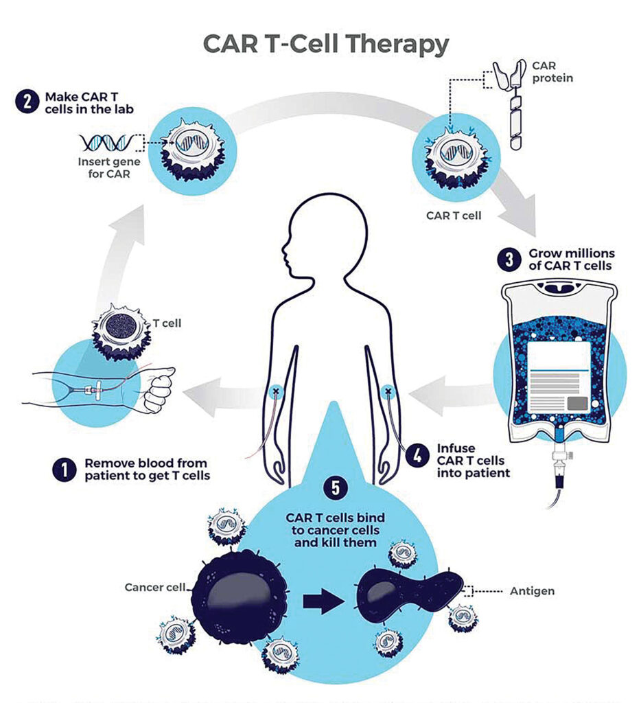 Summary of the CAR T therapy process