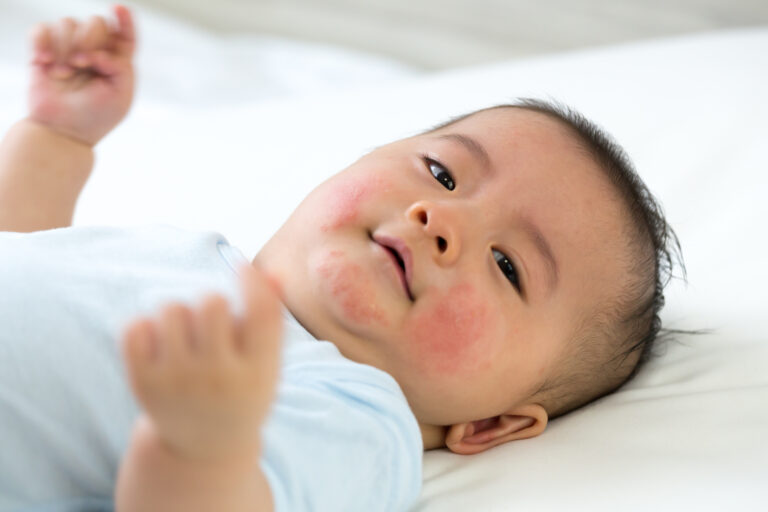 Asian looking baby with black hair and pale skin showing an outbreak of eczema on their face.