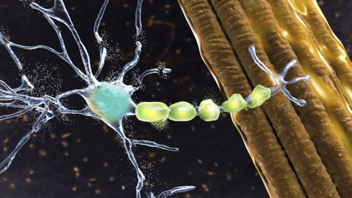 Degradation of a motor neuron presented as an illustration. Shows the kind of damage seen in ALS, which may be worsened by alpha-5 integrin