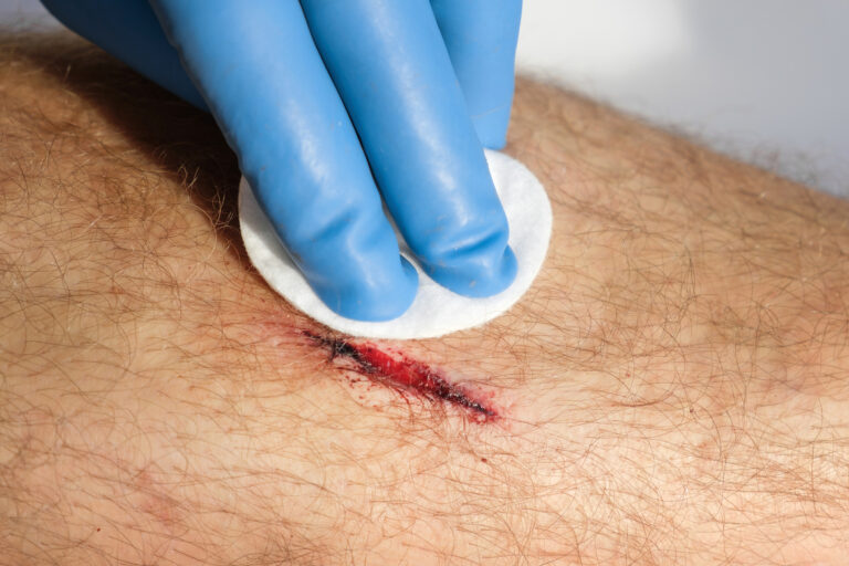 Pocket-Sized Device Can Help Clinicians Quickly Identify Infected Wounds