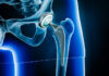 3D Printed Materials Could Reduce Infections after Joint Replacements