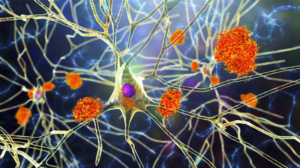 Nerve cells affected by Alzheimer's disease, illustration