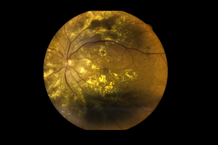 Photo of human retina showing severe age-related macular degeneration.
