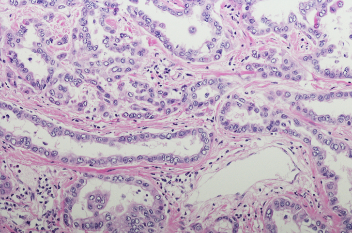 Micrograph of Pleural Mesothelioma with tubule/papillary pattern.