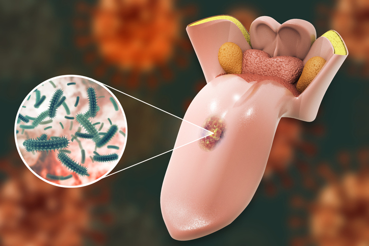 Tongue cancer medical concept or squamous cell carcinoma as malignant tumor disease. 3d illustration
