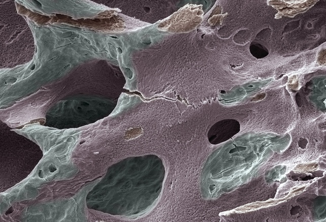 osteoporosis