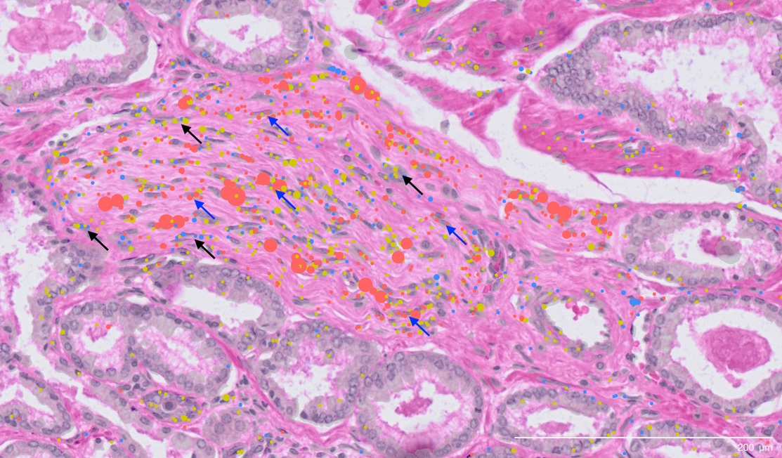 Prostate Cancer Cell Atlas Reveals Shortcomings of Current