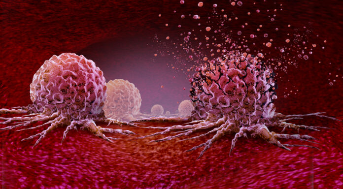 1889191859 New Cancer Treatment